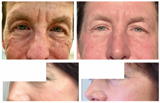 BioVer-X™: Clinically Proven to Reduce Wrinkles in Just 4 Weeks