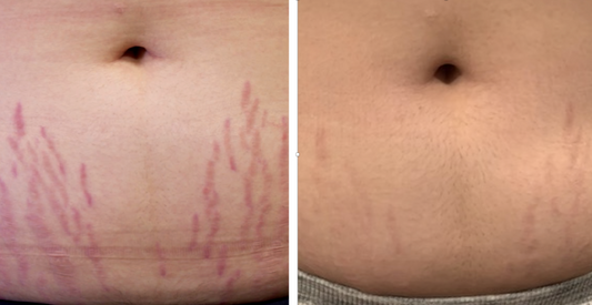 BioVer-X™: Clinically Proven to Reduce Stretch Marks in Just 49 Days
